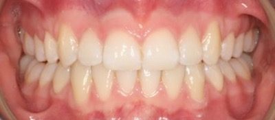 vorher/nachher Zahnkorrektur – Jugendlicher Patient / Invisalign